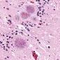 Creutzfeldt-Jakob disease. © Science Photo Library