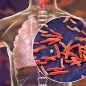 Tuberculosis