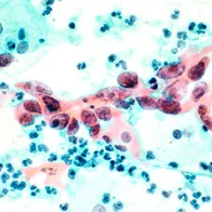 Cytological Specimen Showing Cervical Cancer. Credit: US National Cancer Institute