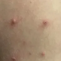 Picture of monkeypox lesions