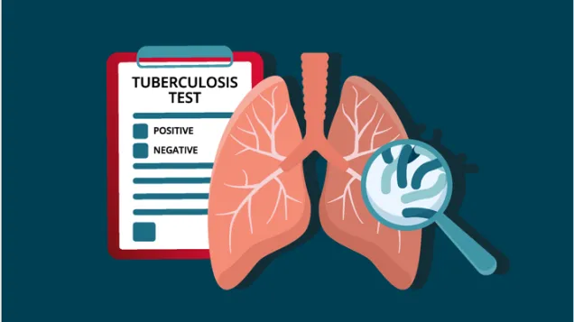 Have you been in close contact with someone who has TB?