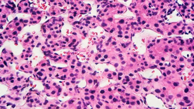 Hepatitis virus particles, TEM. © Science Photo Library