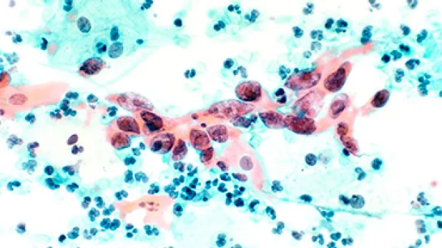 Cytological Specimen Showing Cervical Cancer. Credit: US National Cancer Institute