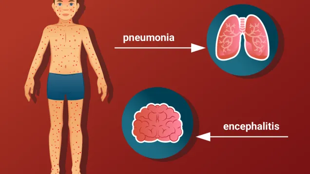 Social media card: Protect yourself from measles