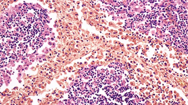 Typhoid nodules, light micrograph. © Science Photo Library