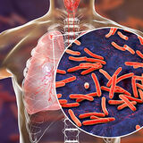 Tuberculosis