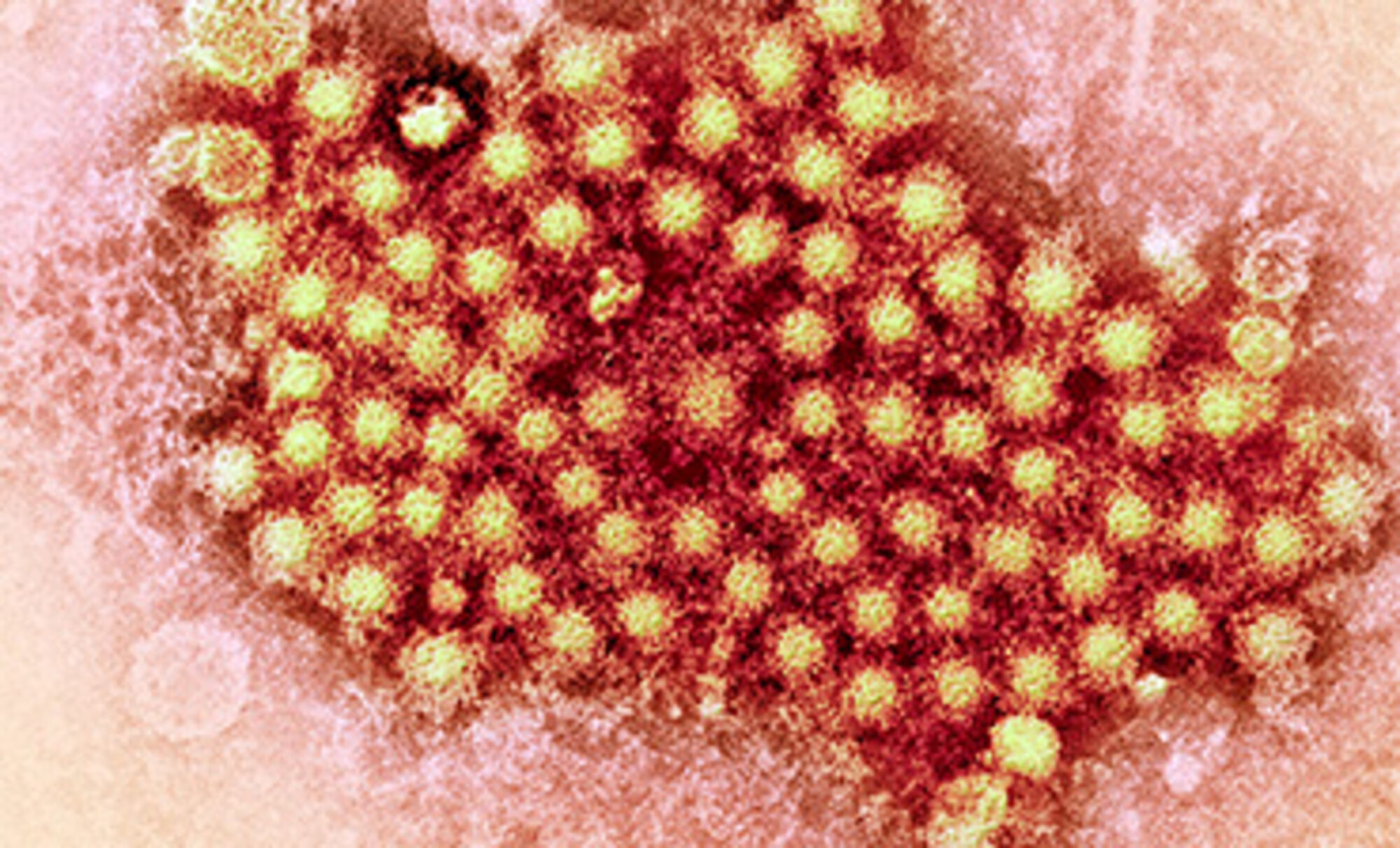 Кишечные инфекции вирусный гепатит. Энтеровирус под микроскопом. Энтеровирусная пузырчатка. Ротавирус энтеровирус Коксаки.