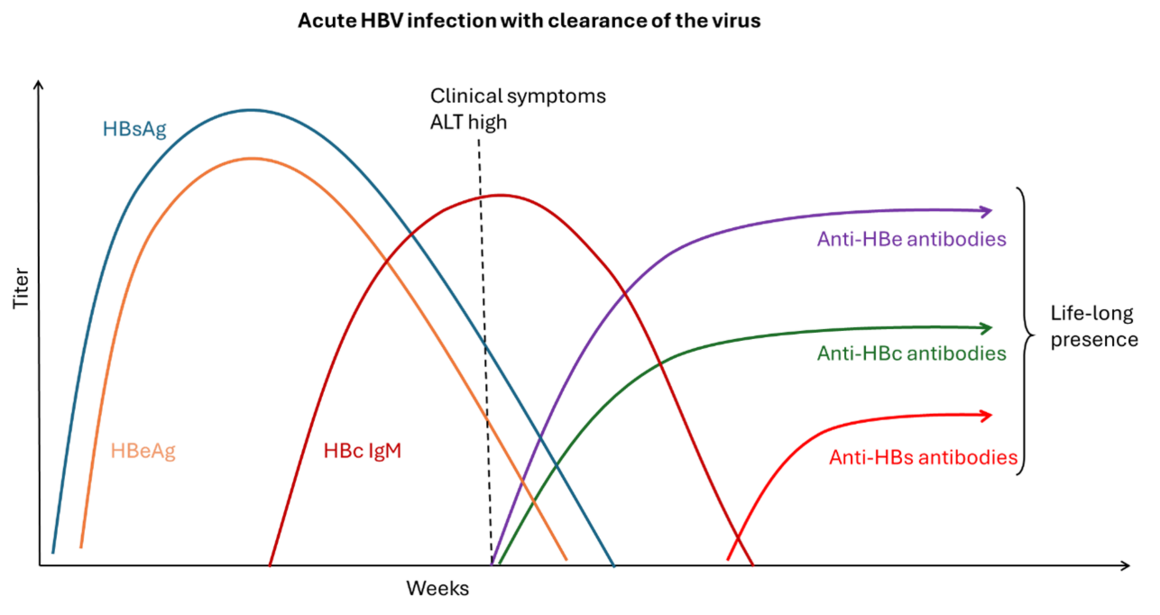 Acute HBV infection with clearance of the virus