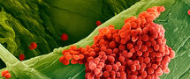 Pneumococcal-disease_C Thumbnail